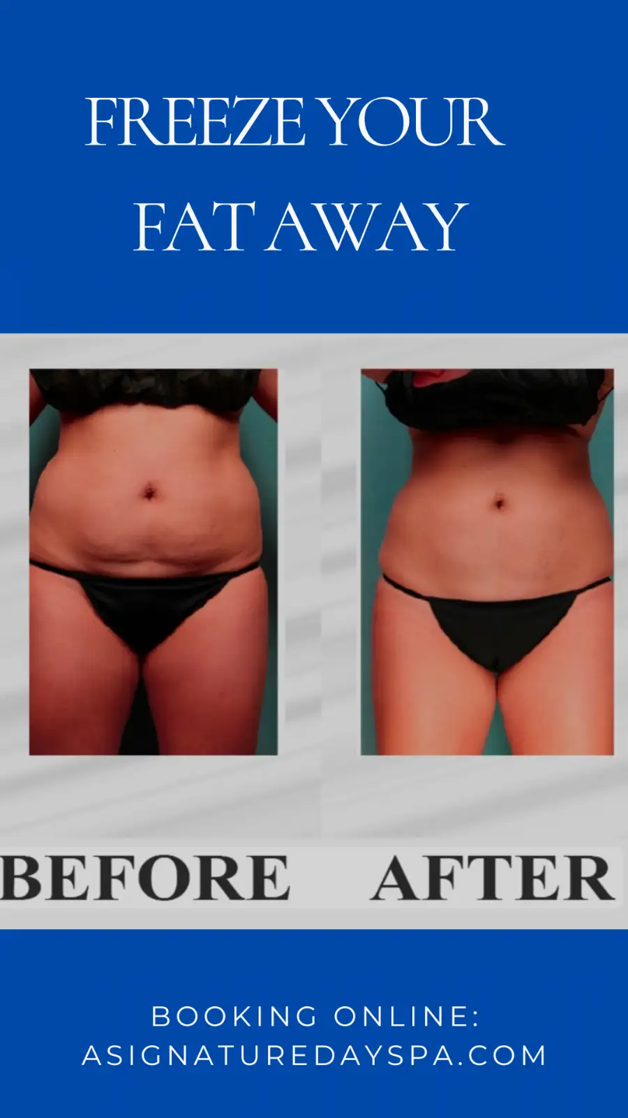 Freeze Your Fat Away